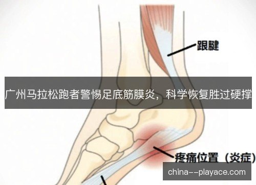 广州马拉松跑者警惕足底筋膜炎,科学恢复胜过硬撑 广州马拉松跑者警惕足底筋膜炎,科学恢复胜过硬撑